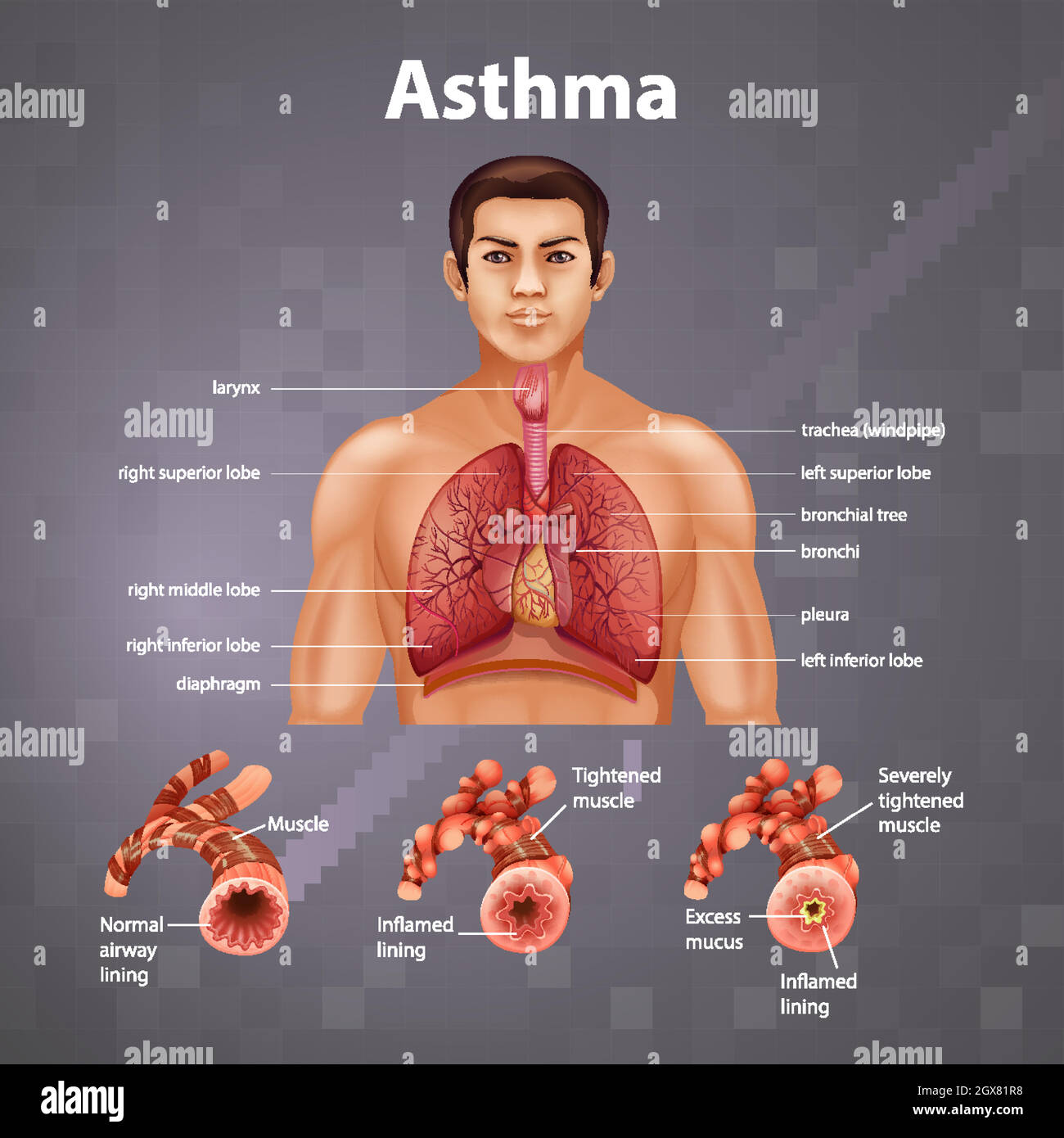 Human anatomy Asthma diagram Stock Vector