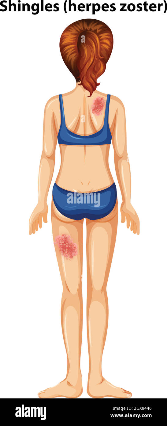 Women with shingles herpes zoster Stock Vector