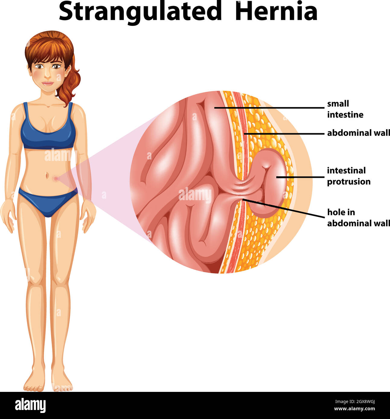 Woman Strangulated Hernia Diagram Stock Vector