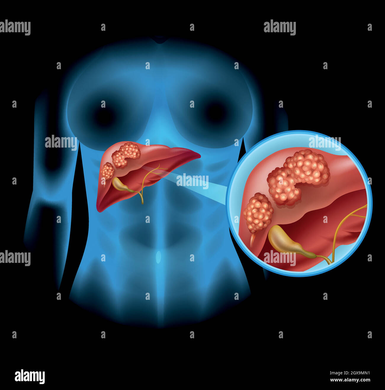 Liver Cancer diagram in detail Stock Vector Image & Art Alamy