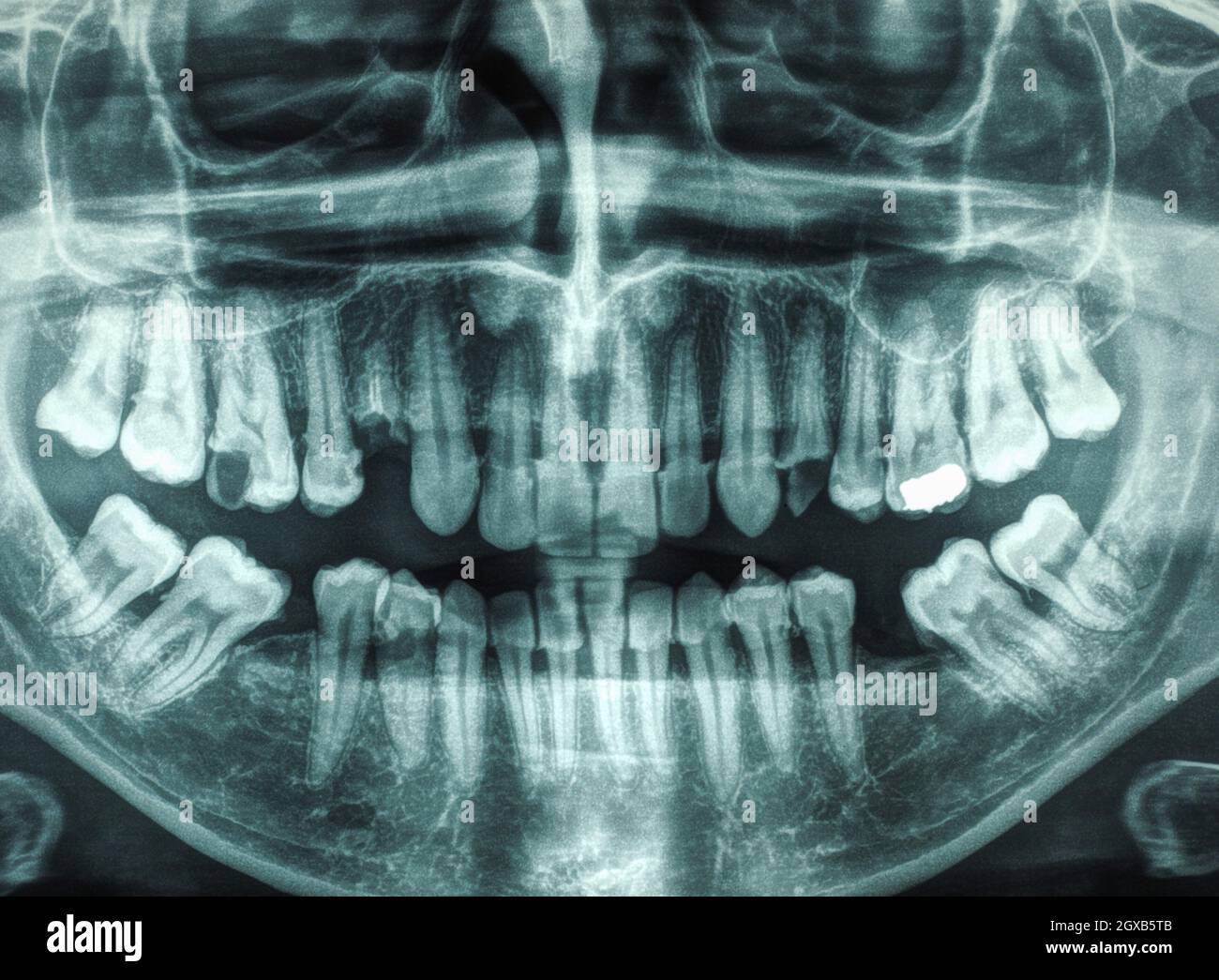 X ray of human mouth with teeth bones. Stock Photo