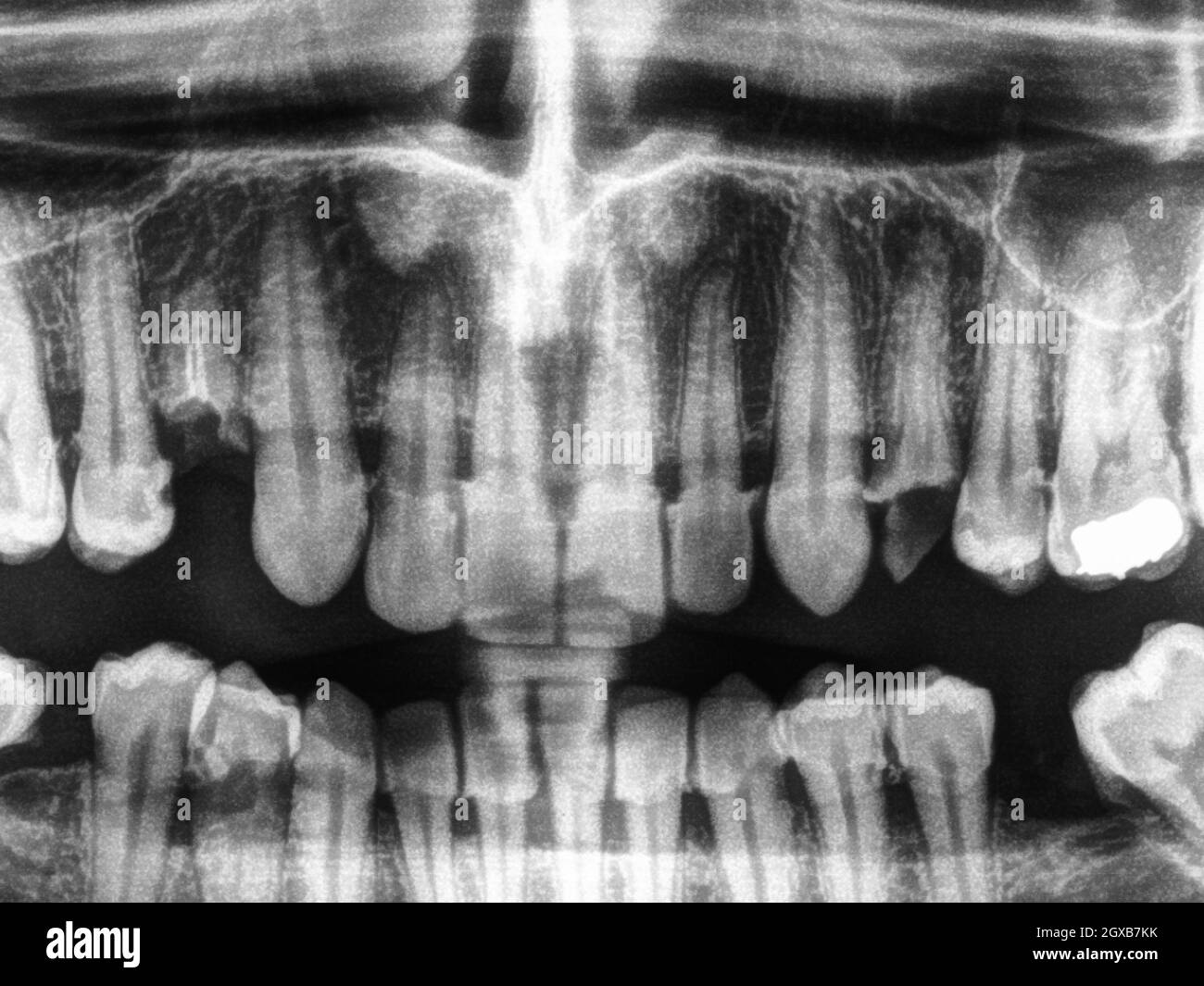 X ray of human mouth with teeth bones in black and white. Stock Photo