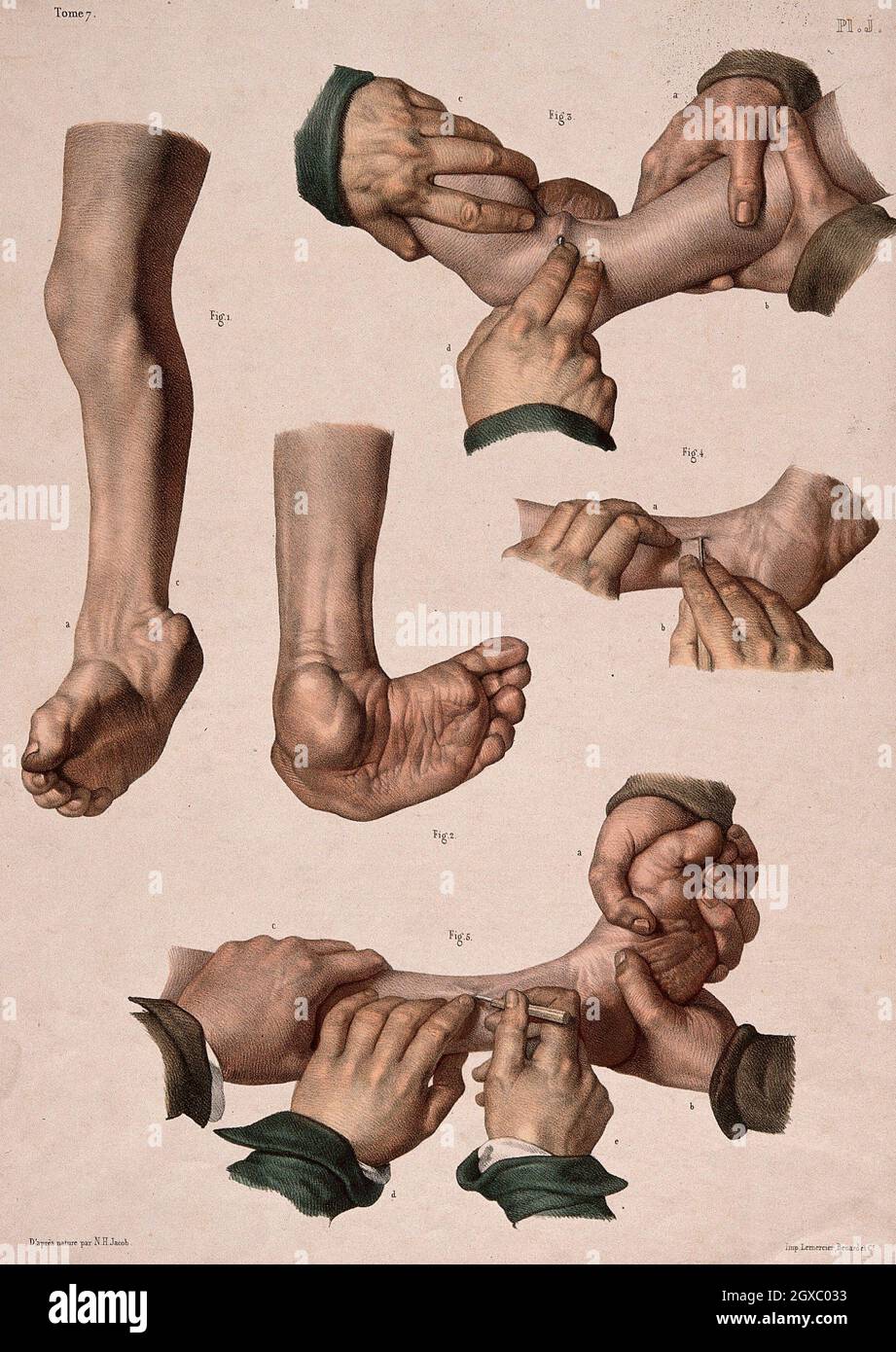 Clubfoot Hi Res Stock Photography And Images Alamy