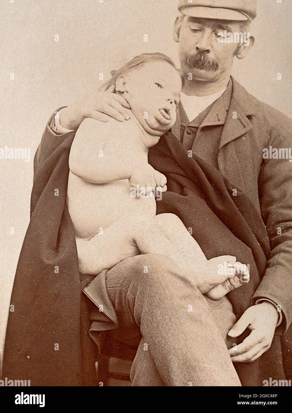 George Edward Shuttleworth holding a male child, showing signs of Down's syndrome, upon his lap. Photograph, 1895. - Contributors Shuttleworth, G. E. Stock Photo