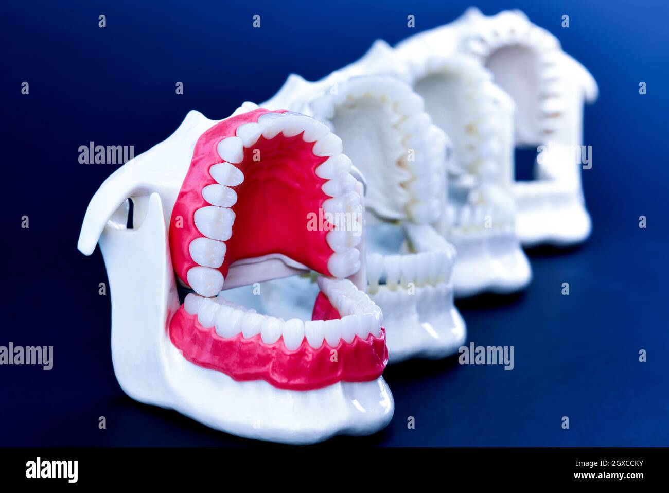 Dentist orthodontic teeth models with jaws opened on blue background