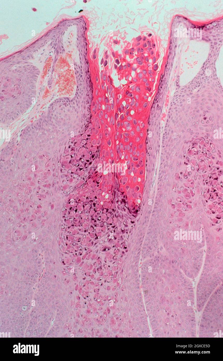 Molluscum contagiosum. Description This medium power view shows skin