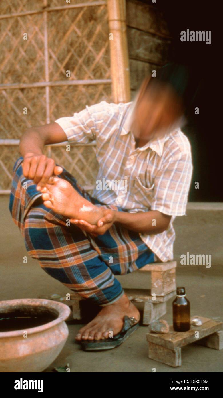 Leprosy hand hires stock photography and images Alamy