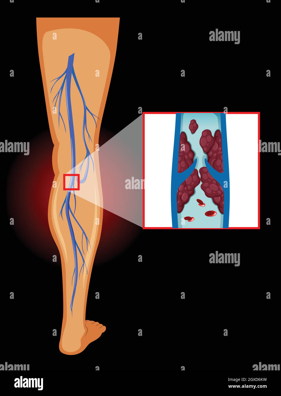 Medical Image of Varicose Veins Stock Vector