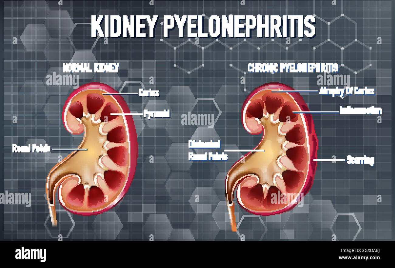 Informative illustration of Pyelonephritis Stock Vector