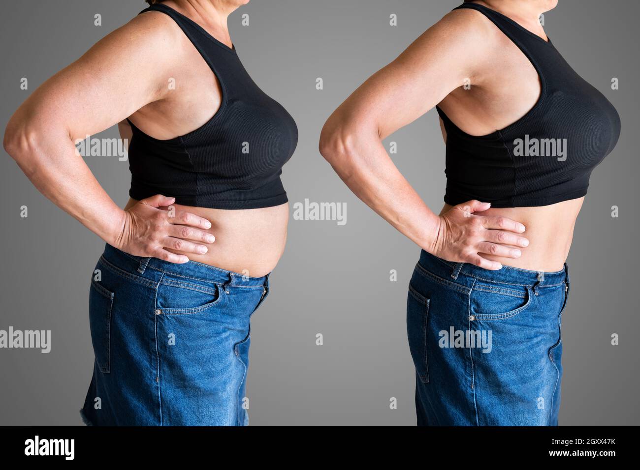 Before And After Weight Loss Liposuction Surgery Stock Photo Alamy