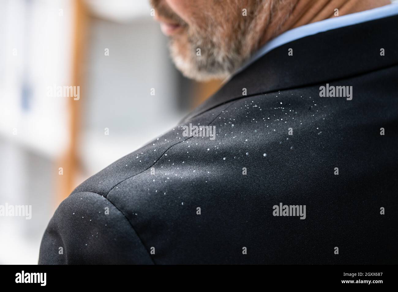 Man Dandruff On Suit Shoulder. Brushing Clothes Stock Photo Alamy