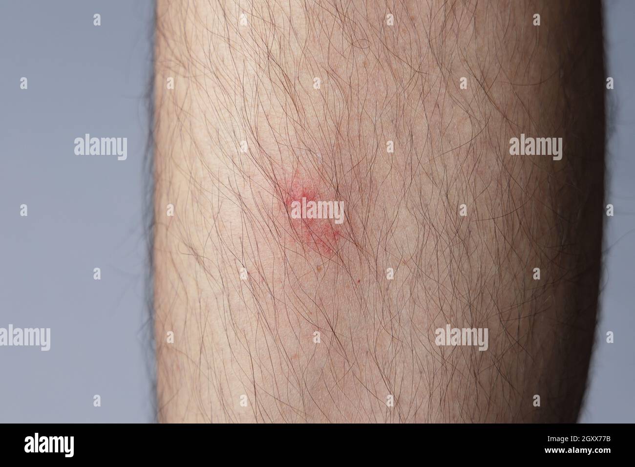 Itchy mosquito bite on male’s leg. Aedes albopictus or tiger mosquito Stock Photo