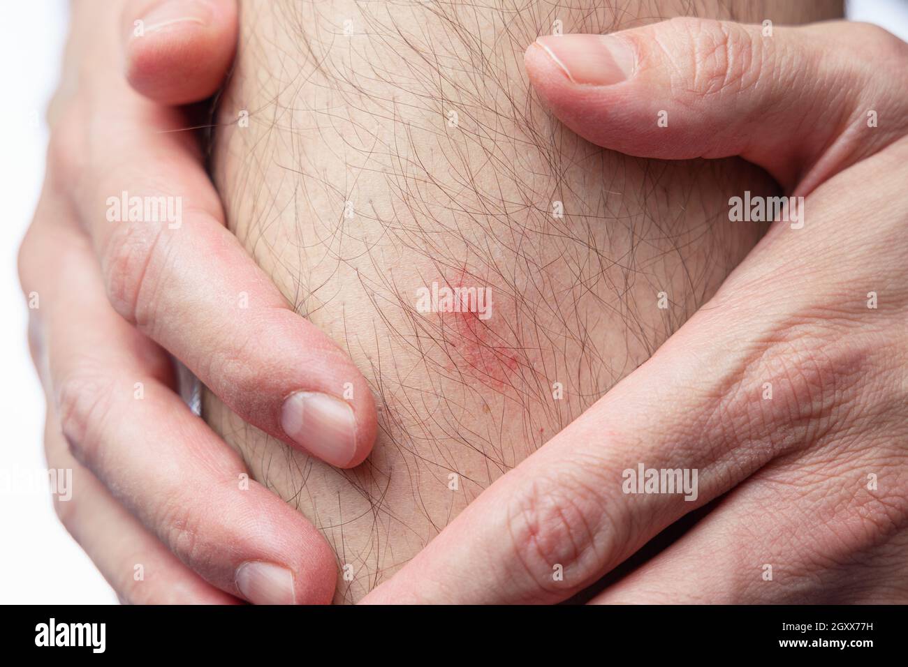 Itchy mosquito bite on male’s leg. Aedes albopictus or tiger mosquito Stock Photo