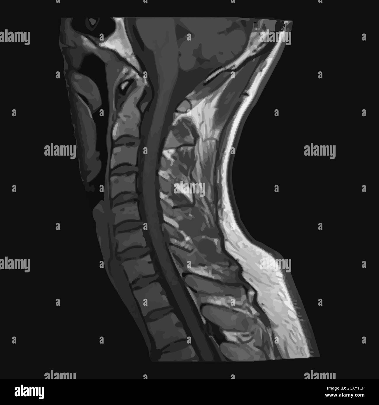 Realistic image sagittal of cervical spine with CT scan, MRI Magnetic resonance imaging layer of spine neck. Isolated on dark background. Vector illus Stock Photo