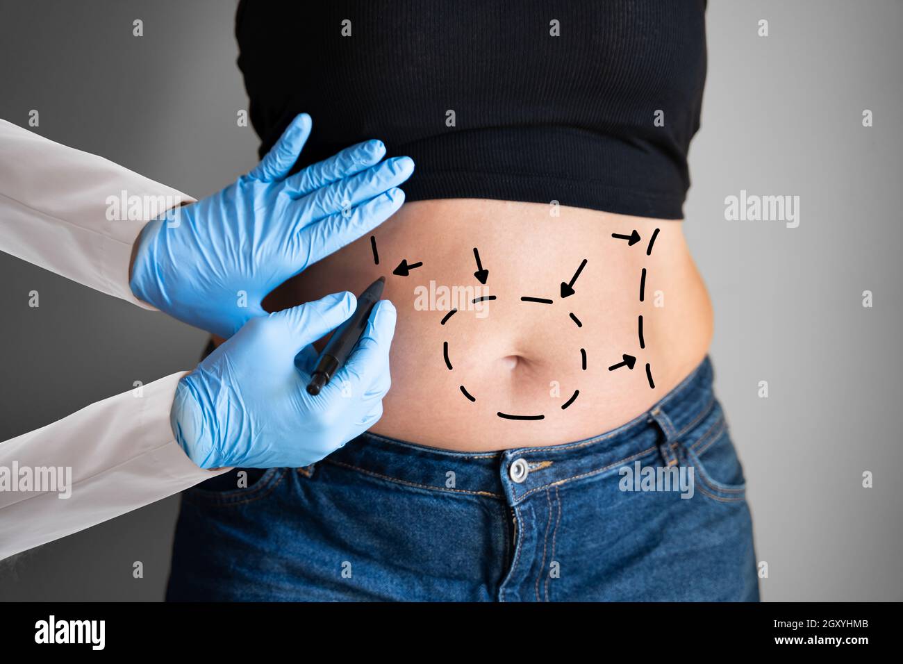 Abdominoplasty Obesity Surgery. Aesthetic Abdominal Fat Liposuction