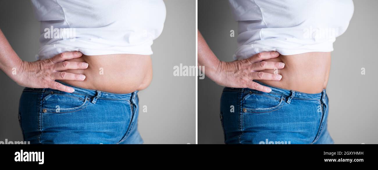 Before And After Weight Loss Liposuction Surgery Stock Photo Alamy