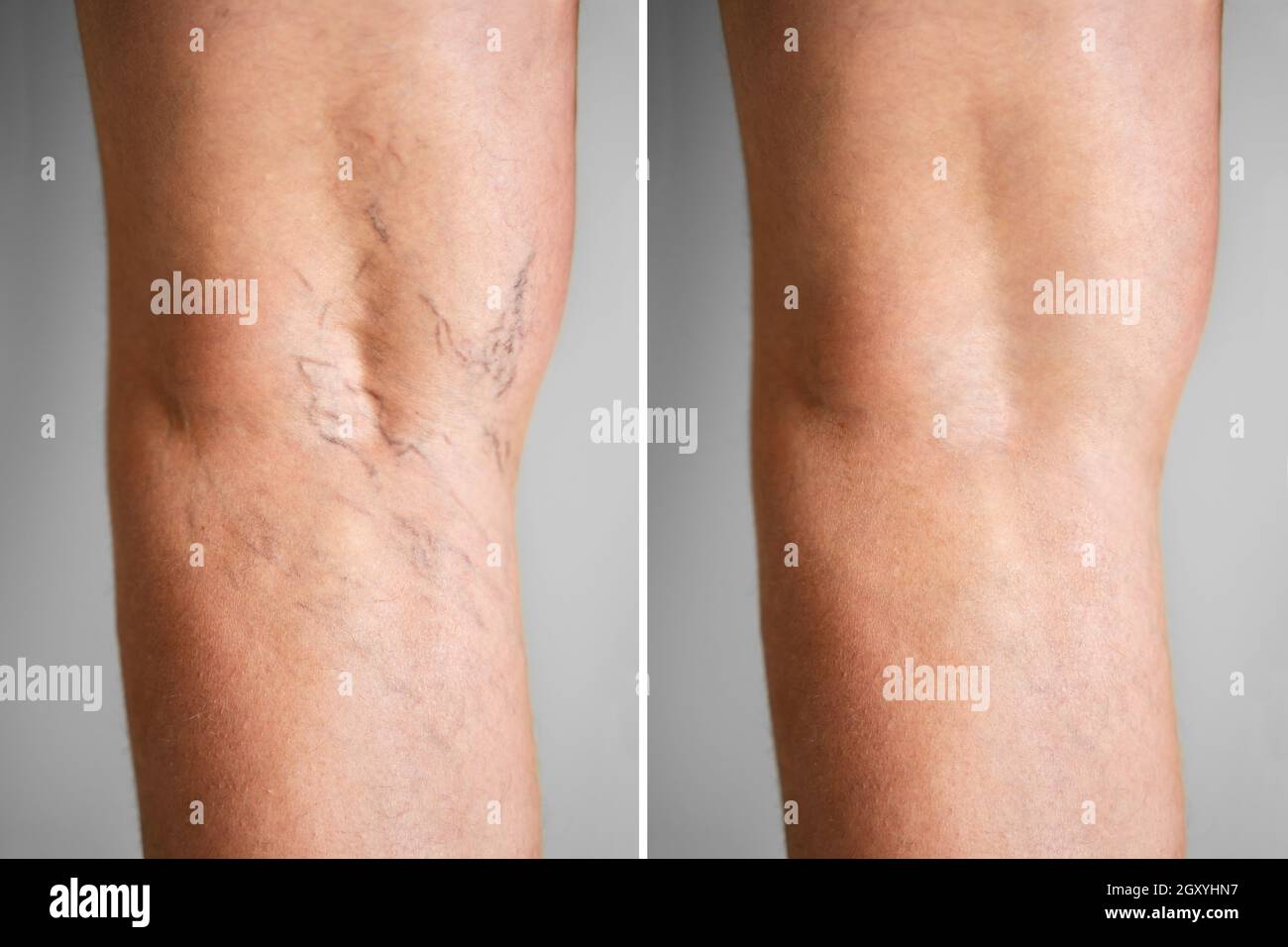 Leg Vein Varicose Before And After Laser Treatment Stock Photo Alamy