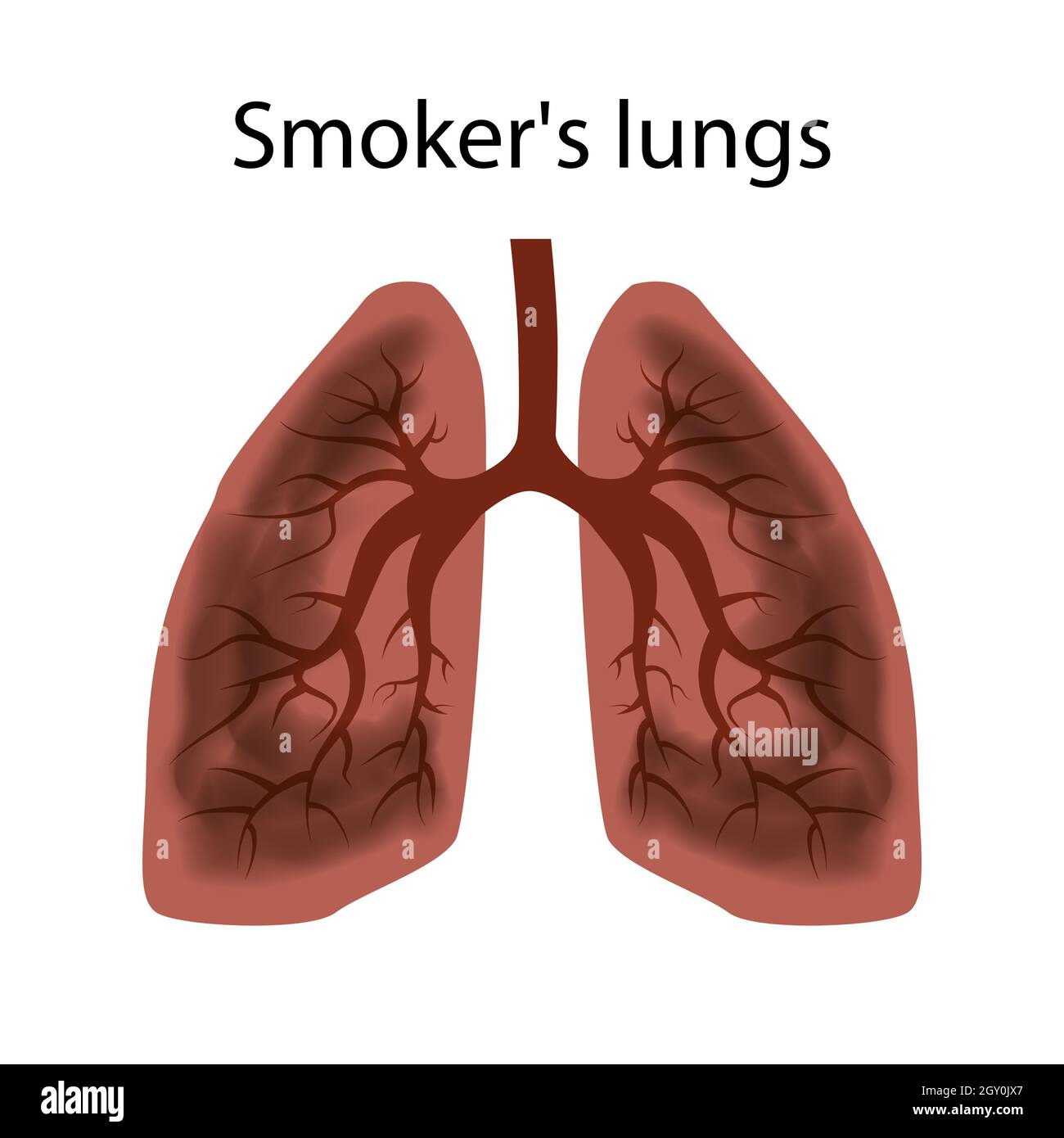 Smoker's lungs. Damage to the lungs of a person caused by smoking. Isolated vector EPS10. Stock Vector