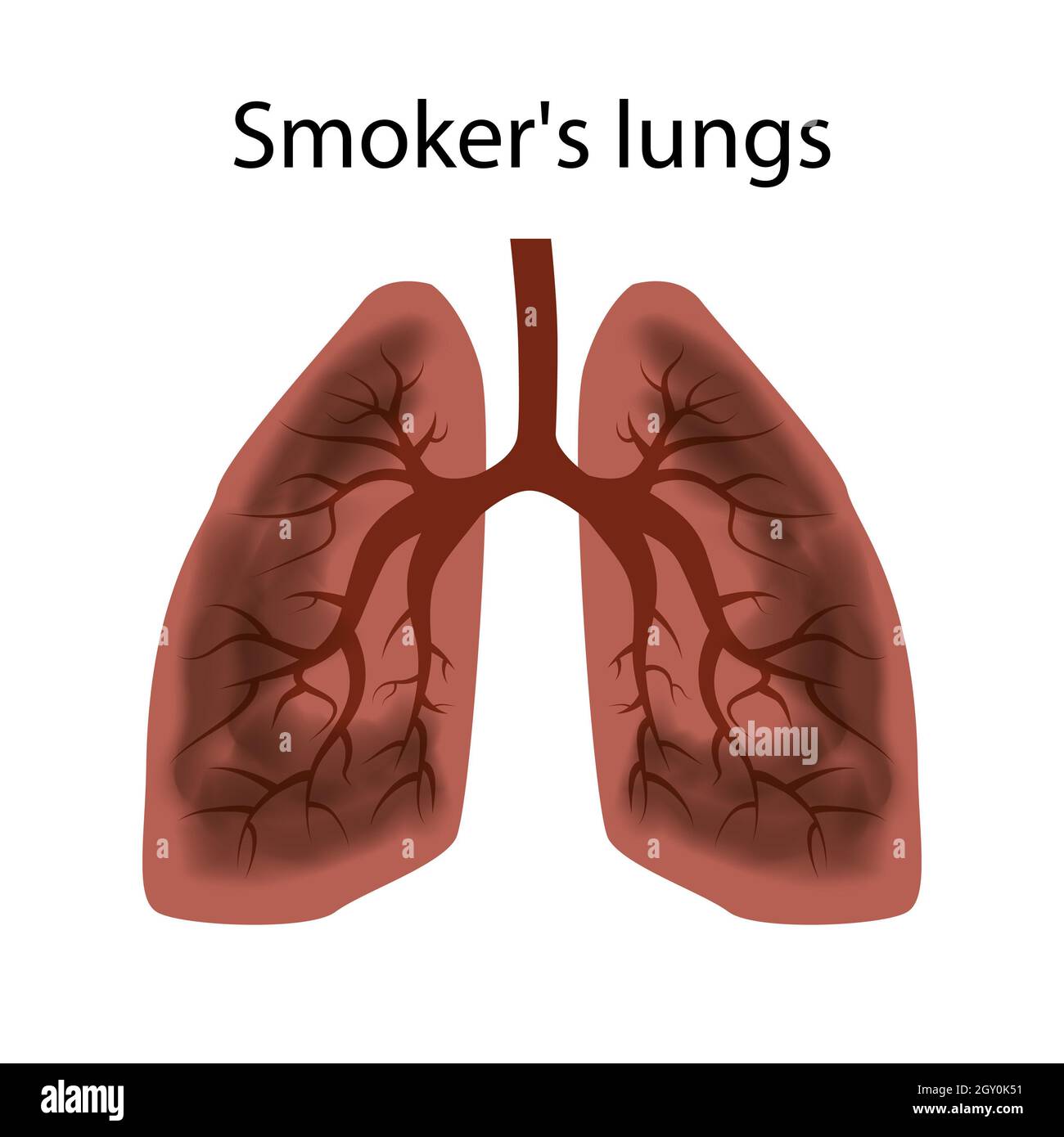 Smoker's lungs. Damage to the lungs of a person caused by smoking. Isolated vector EPS10. Stock Photo