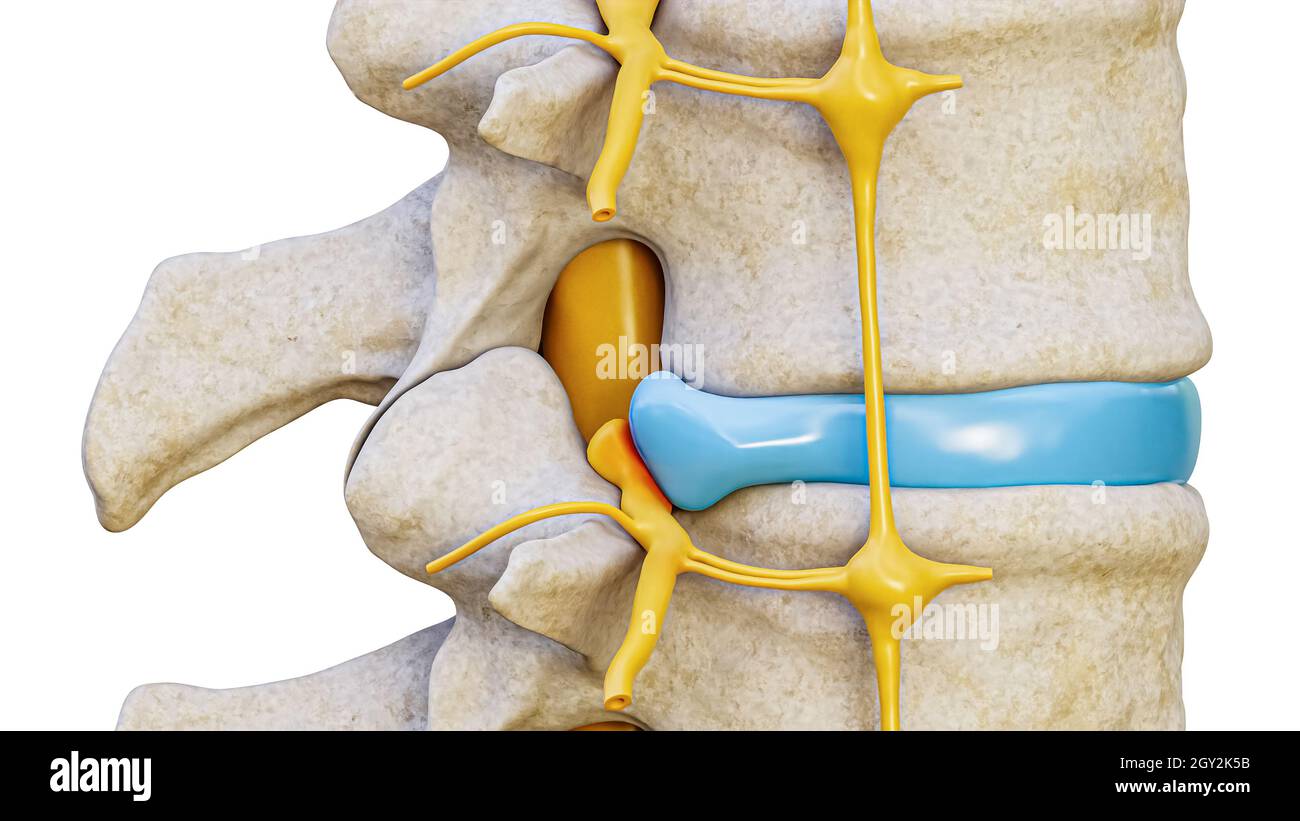 Herniated disc with spinal nerve compression 3D rendering illustration lateral view isolated on white background. Backbone or spinal column injury, an Stock Photo