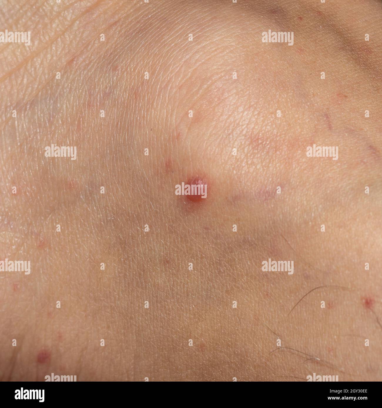 scarlet fever in adult caucasian man Stock Photo