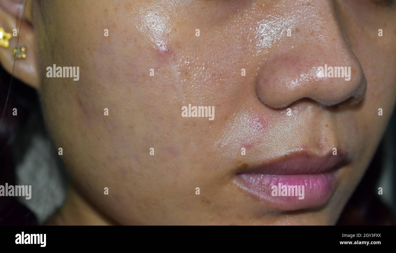 Acne , black spots and scars on oily face of Asian young woman. Closeup  view Stock Photo - Alamy