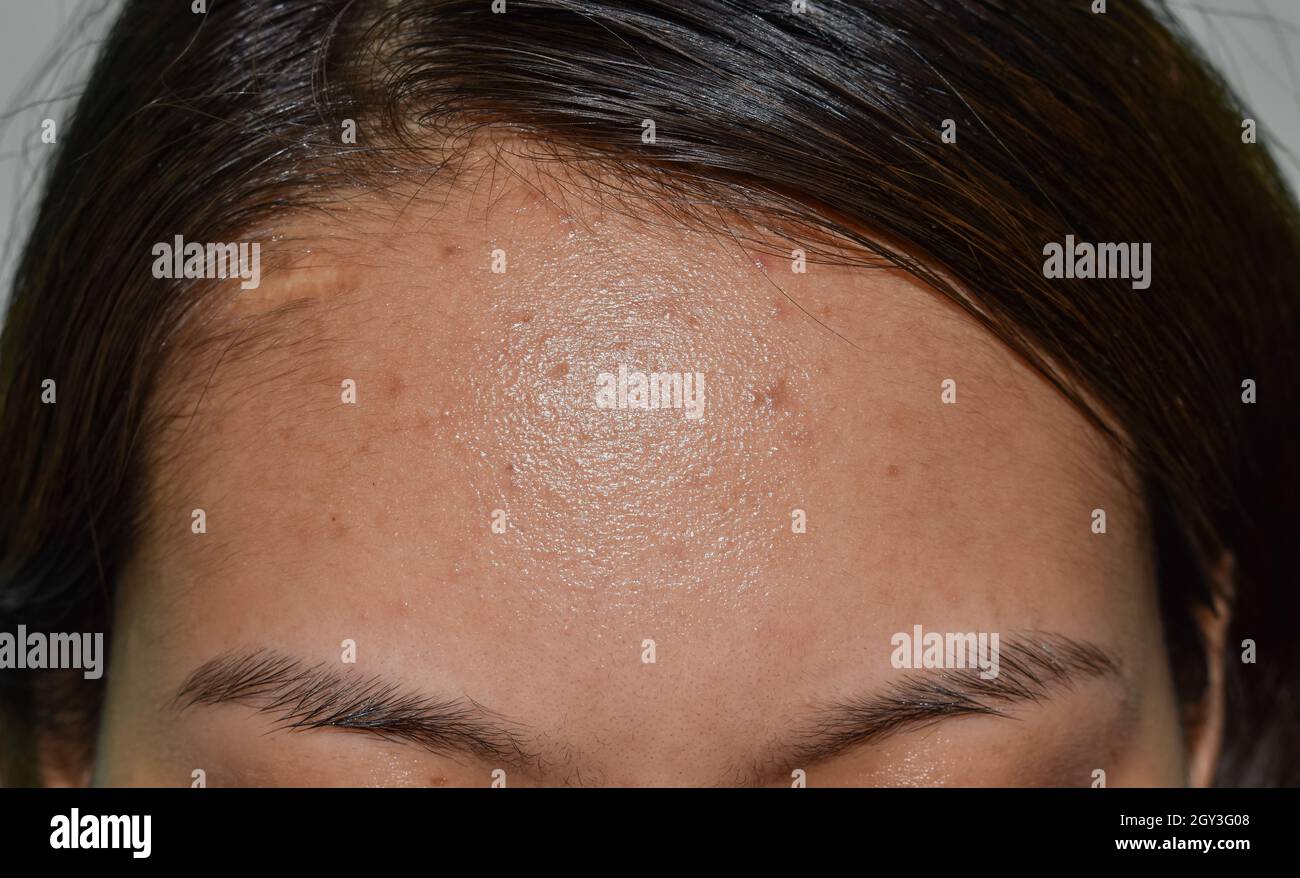 Sebum Plugs Hair Sebum Plugs Hair