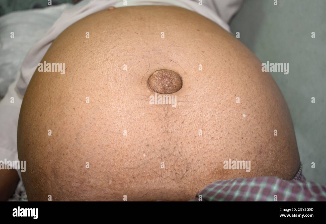 Abdominal fat in patient with ascities and paraumbilical hernia. Flank is full. Stock Photo