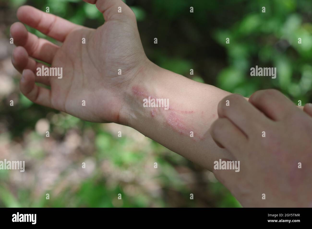 A closeup of a woman scratching her poison ivy while on a hiking trail