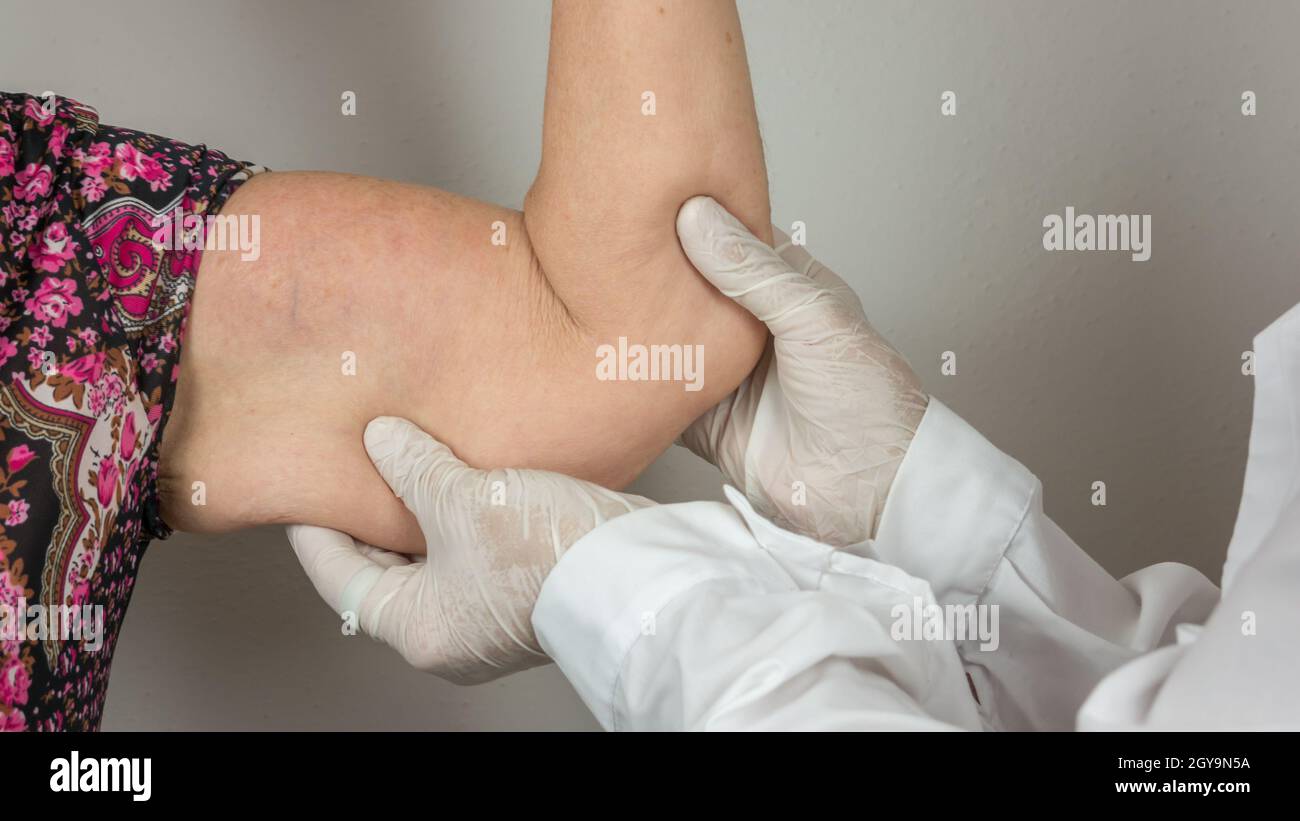 surgeon doing a medical check up by palpating the forearm, on adipose tissues, cellulite, on a female patient with, seen from the front. Stock Photo