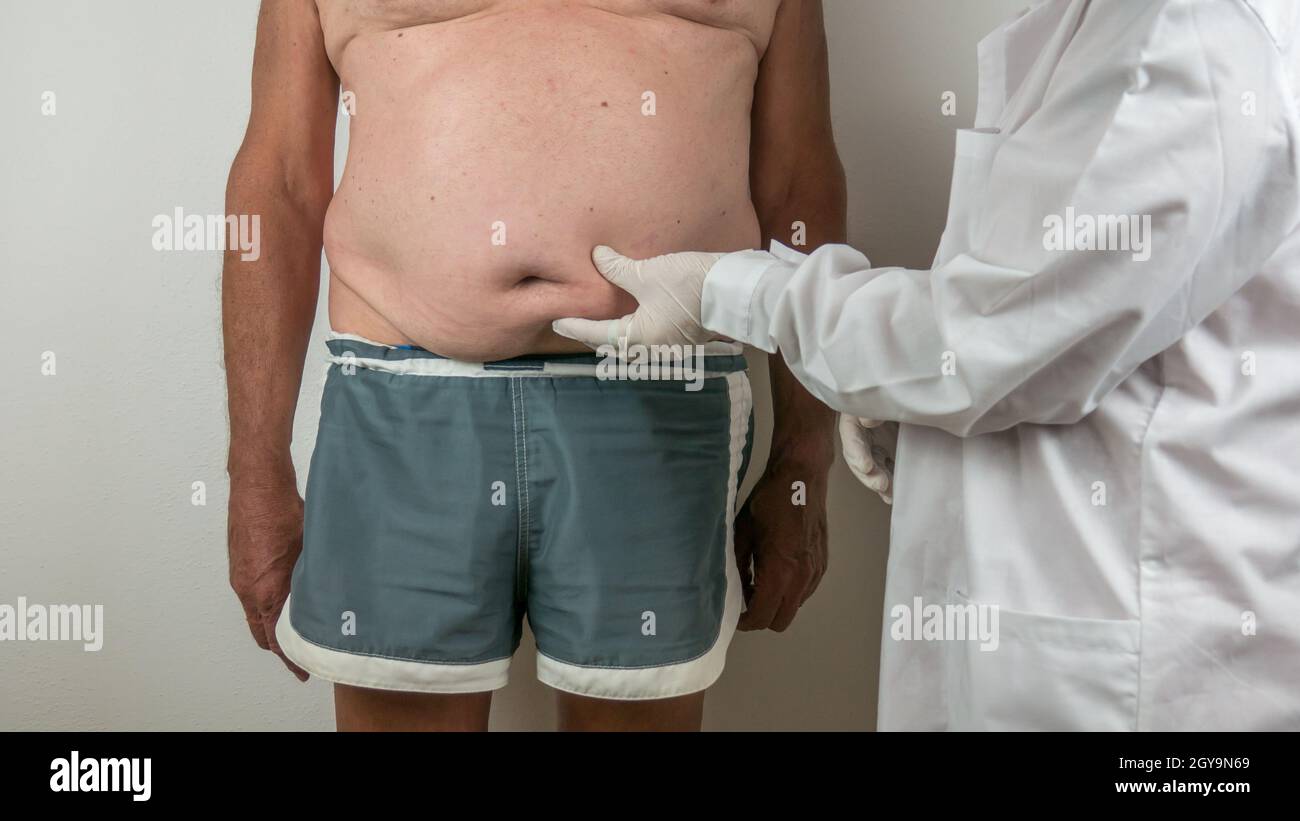 surgeon doing a medical doing checkup by palpating the belly on adipose tissues, cellulite, on a man patient with a flacid belly, seen from the front Stock Photo
