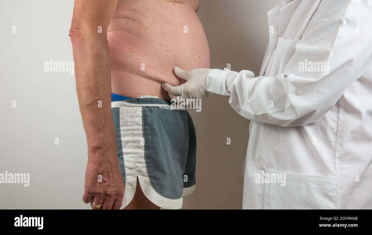 surgeon doing a medical check up by palpating the belly on adipose tissues, cellulite, on a man patient with a flacid belly, seen from the side profil Stock Photo