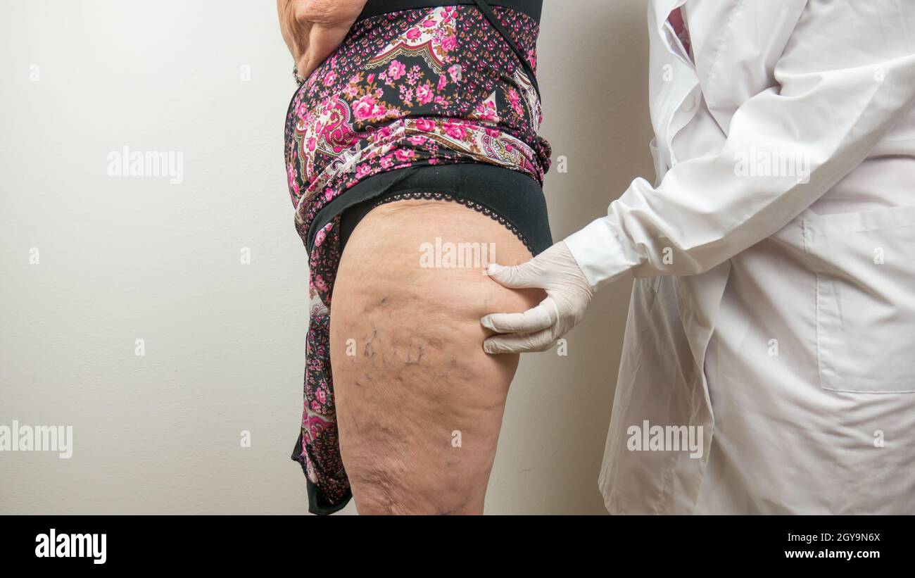 surgeon doing a medical check up by palpating the buttock, on adipose tissues, cellulite, on a female patient with, seen from the side profile. Stock Photo