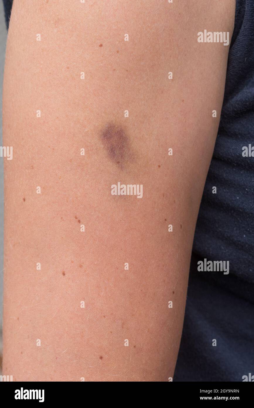 Hematoma arm hires stock photography and images Alamy