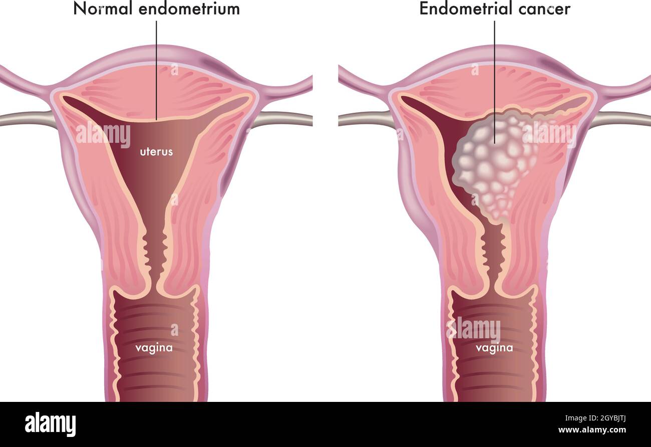 Medical illustration shows a female genital system with a normal endometrium compared with one afflicted of endometrial cancer. Stock Vector