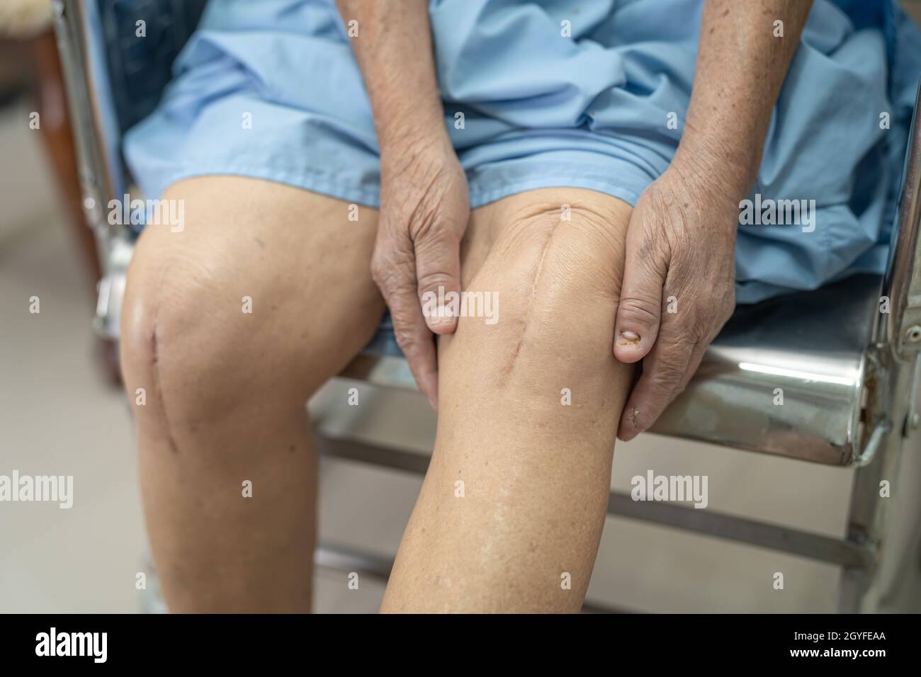 Asian senior or elderly old lady woman patient show her scars surgical total knee joint replacement Suture wound surgery arthroplasty on bed in nursin Stock Photo