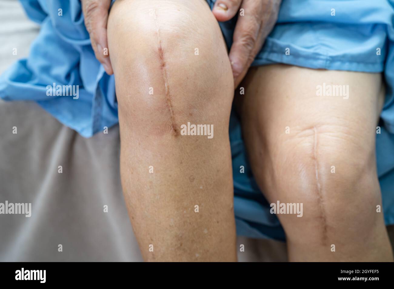 Asian senior or elderly old lady woman patient show her scars surgical total knee joint replacement Suture wound surgery arthroplasty on bed in nursin Stock Photo