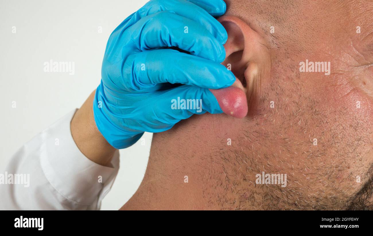 doctor with blue gloves examining an abscess with pus on a swollen and inflamed ear, of a caucasian man. Stock Photo