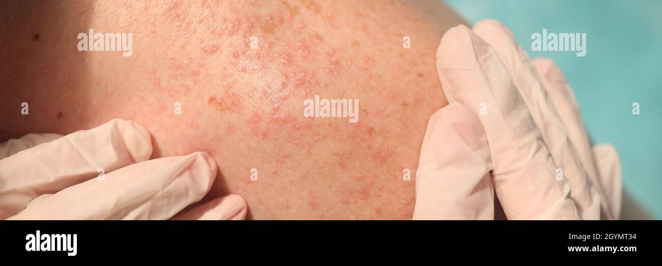 Doctor in rubber gloves examining skin of patient with red rash in clinic closeup Stock Photo