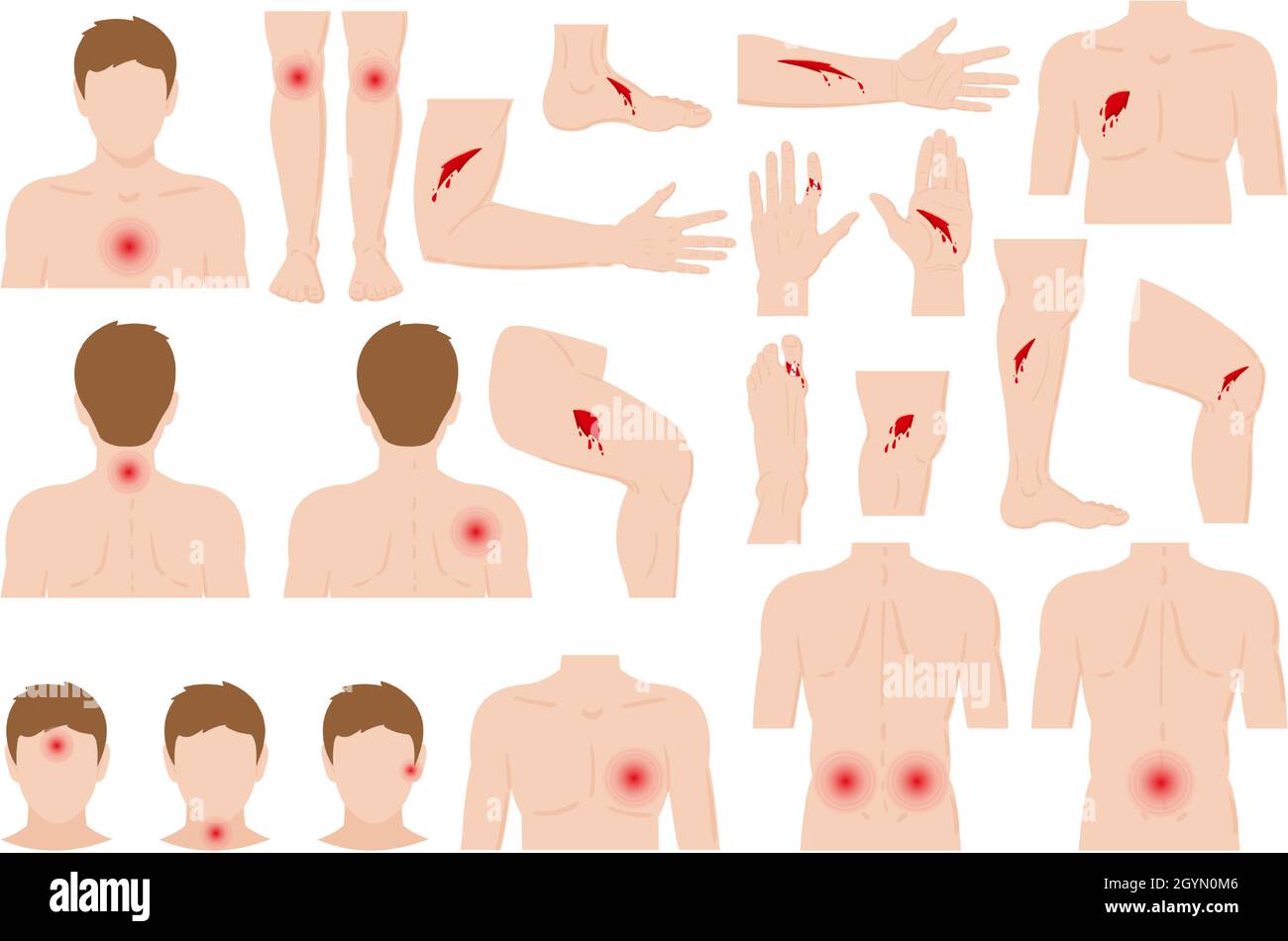 Lastimar Bruise arm Cut Out Stock Images & Pictures - Alamy