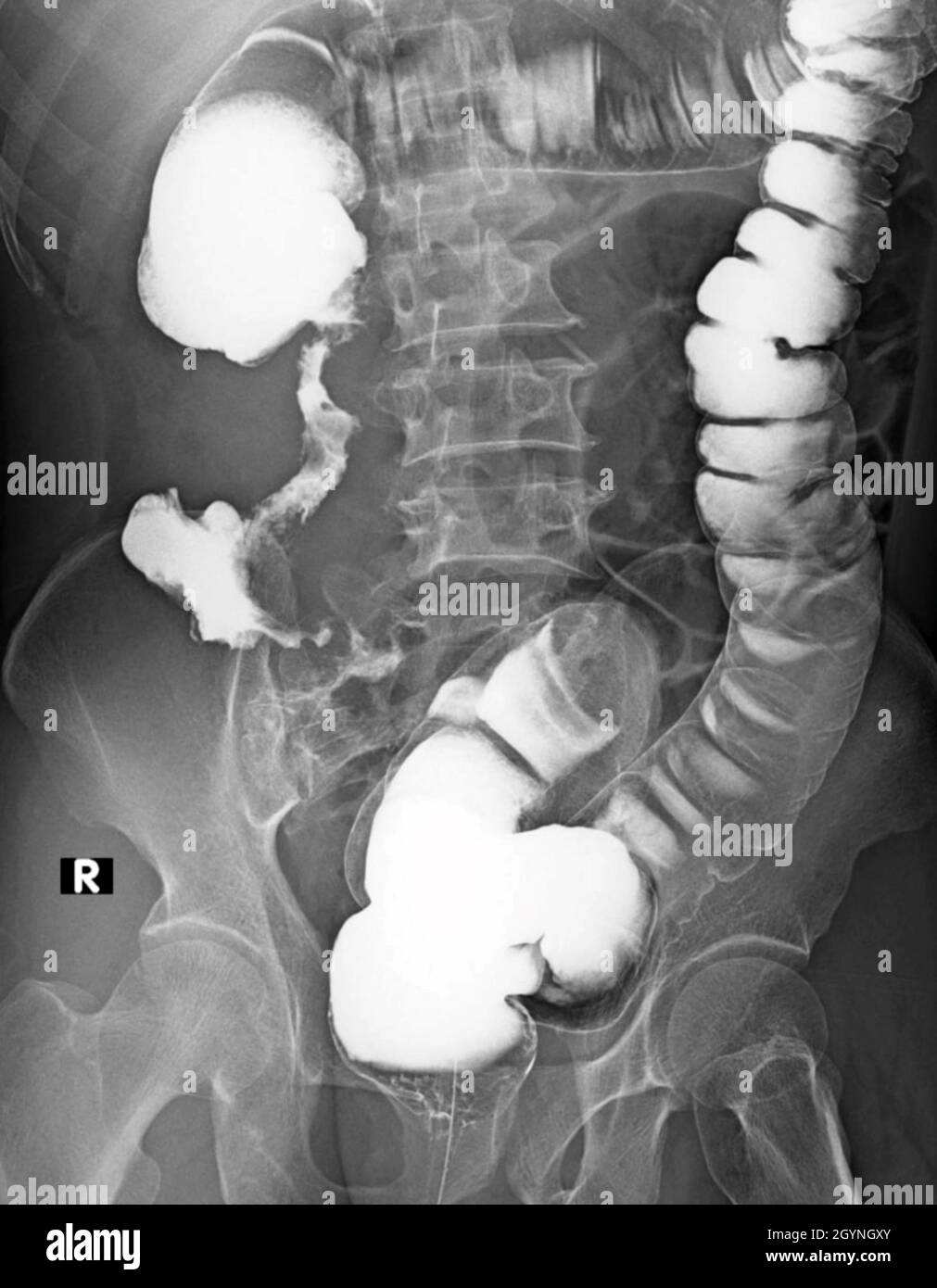 Colorectal cancer, X-ray Stock Photo