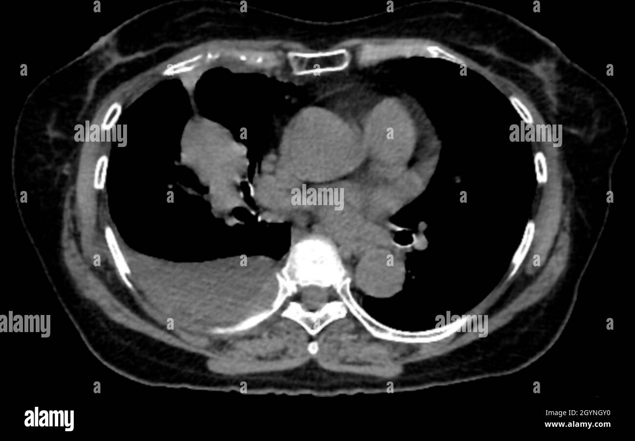 Lung cancer, CT scan Stock Photo
