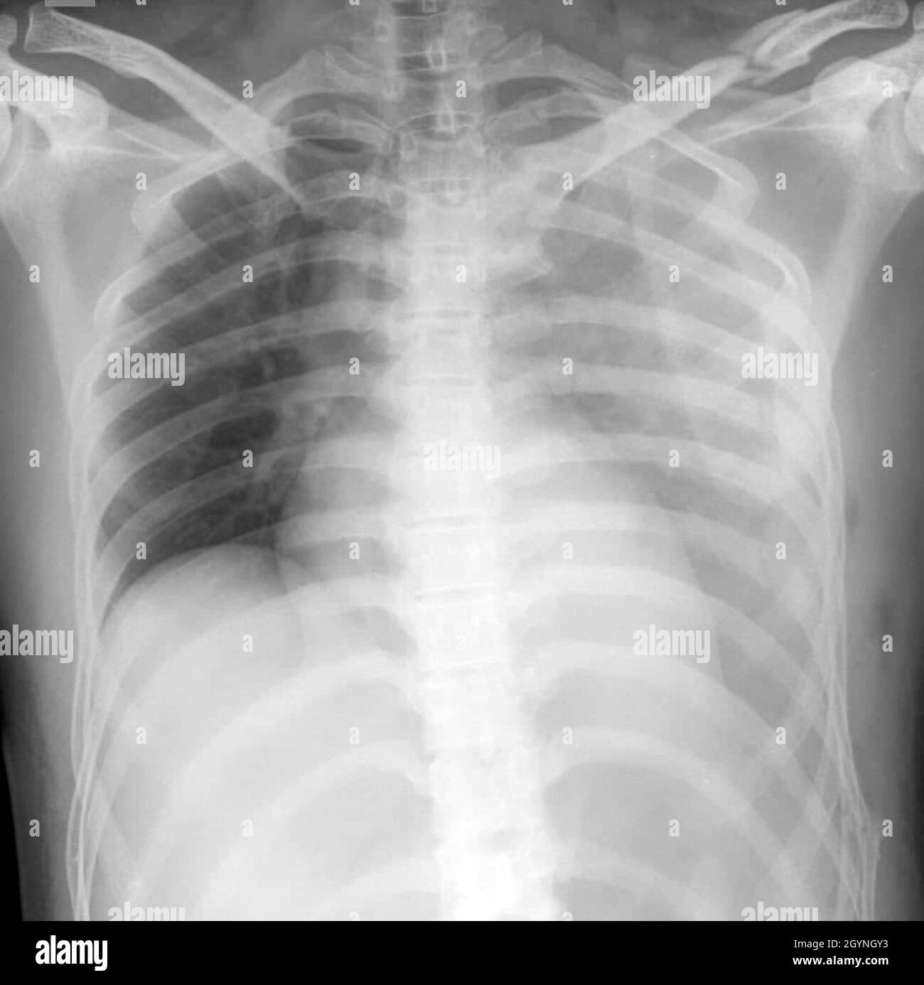 Chest X Ray Hemothorax