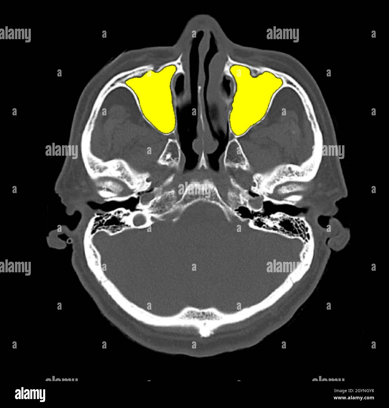 Paranasal sinus anatomy, CT scan Stock Photo