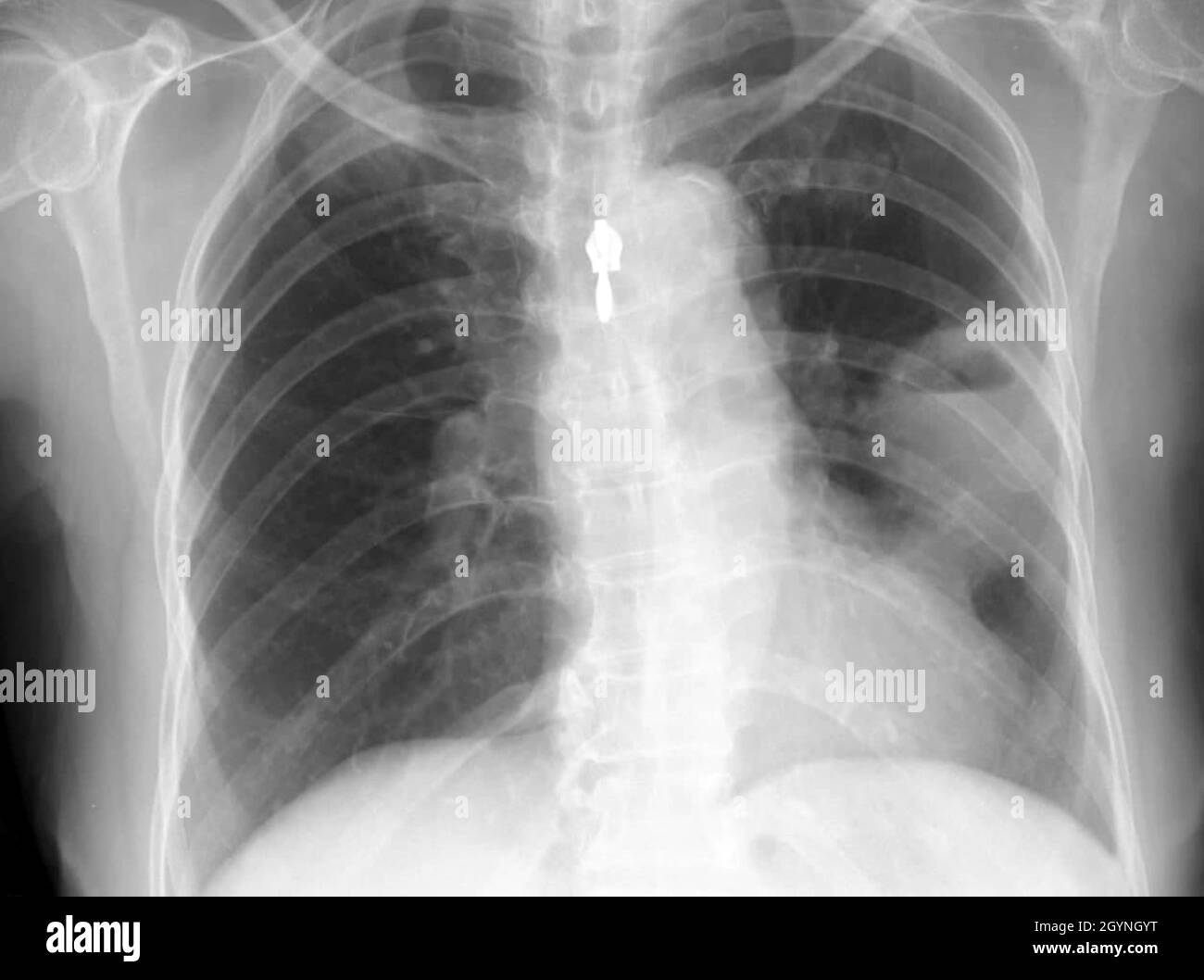 Lung abscess, X-ray Stock Photo