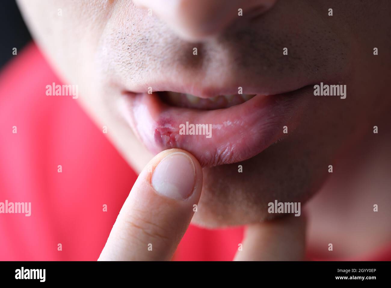 Herpes on male inner lip closeup. Symptoms and treatment of herpes Stock Photo