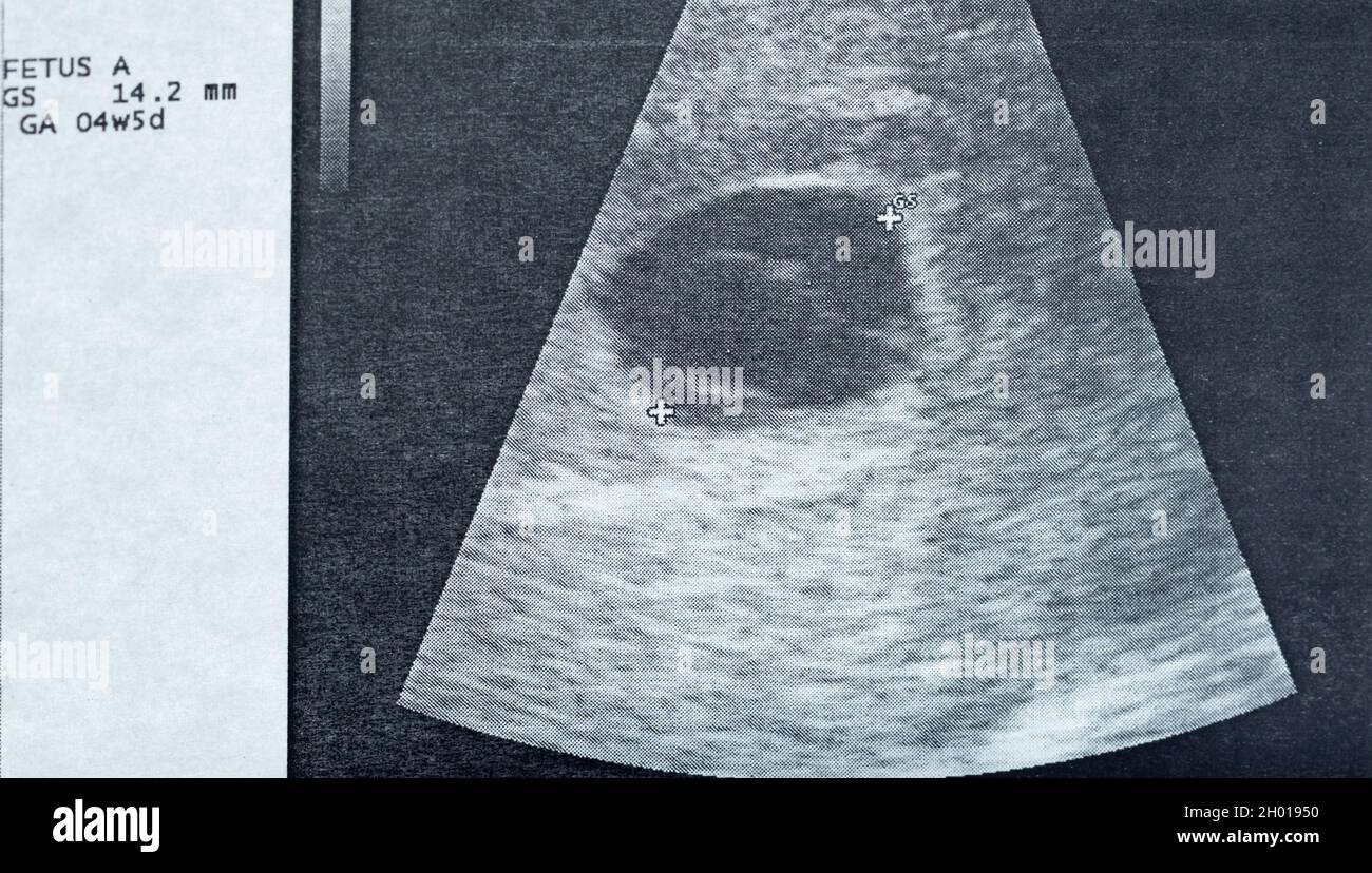 Ultrasound image of the gestational sac and the vitelline bladder with the embryo, of a pregnancy stopped in evolution Stock Photo