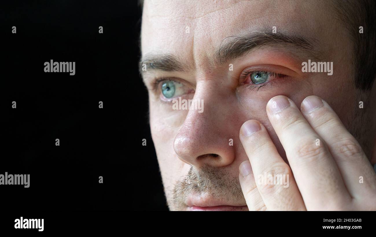 Close Up of Severe Bloodshot Red Blood Eye of Male Affected by