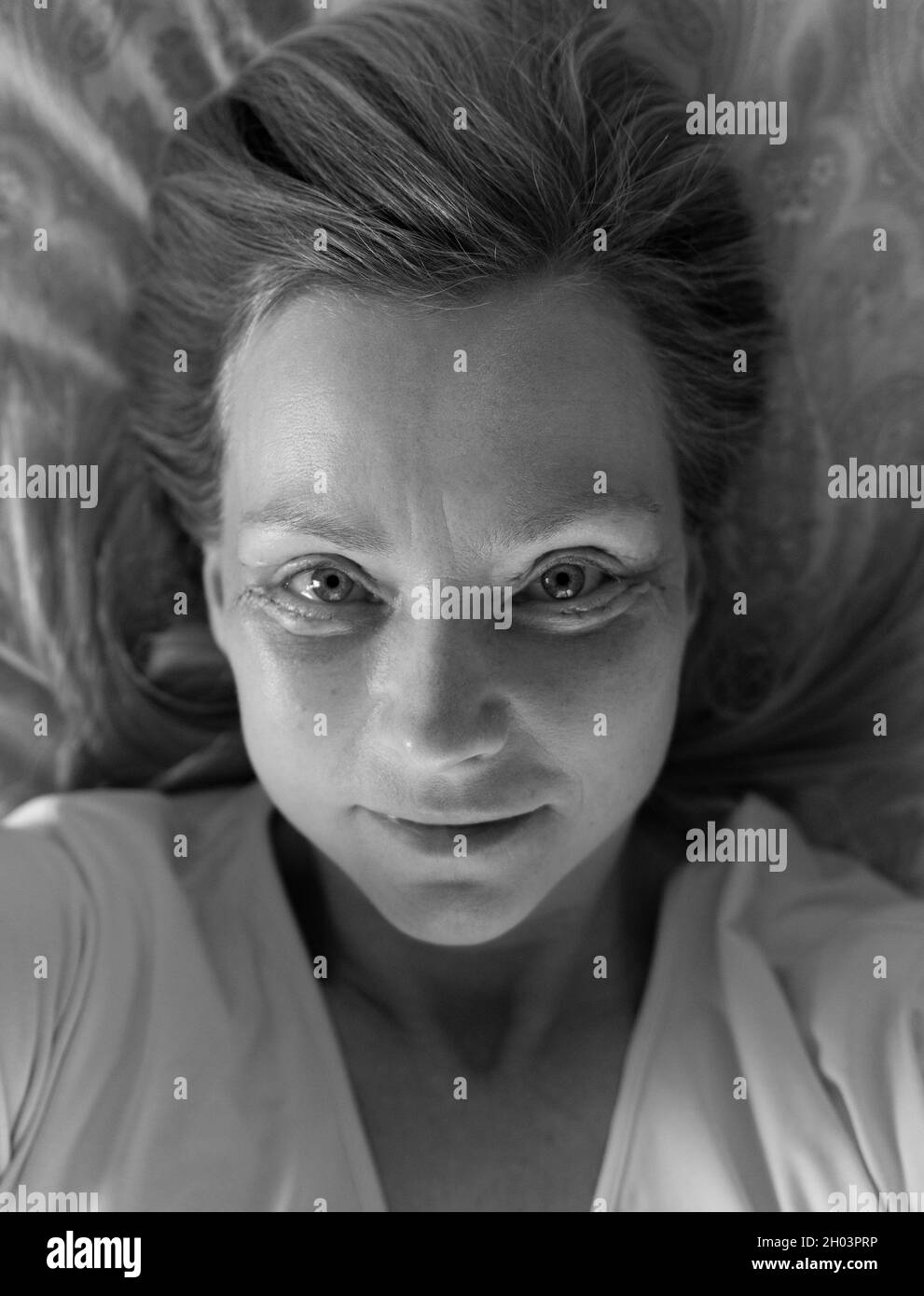 Middle-aged woman selfie seven days after Double Eyelid  blepharoplasty surgery.Black and white. Stock Photo