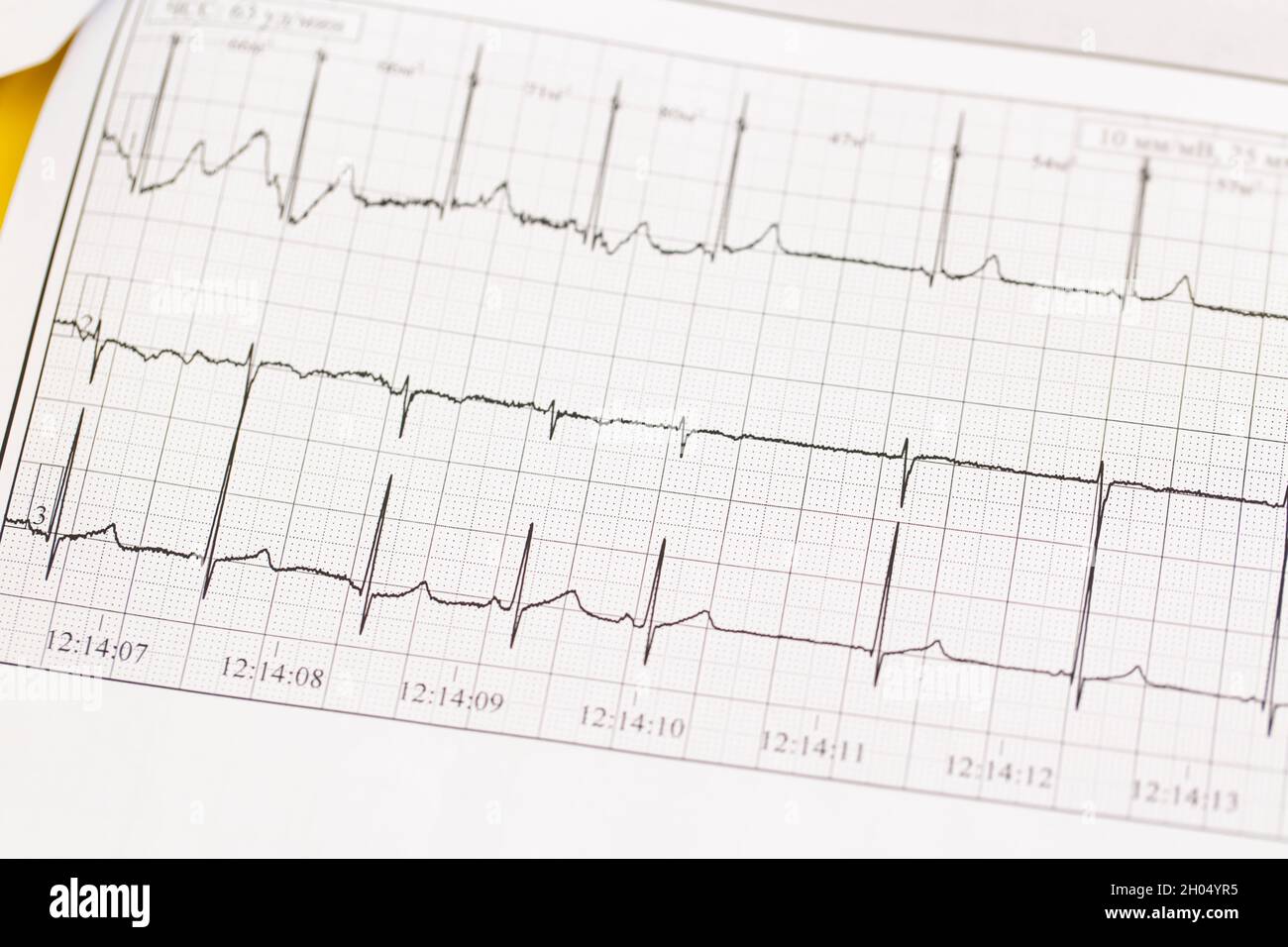 Ecg chart hires stock photography and images Alamy